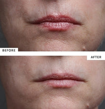 Load image into Gallery viewer, Silc Skin Multi Area Set for Face Wrinkles