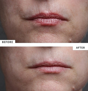 Silc Skin Multi Area Set for Face Wrinkles